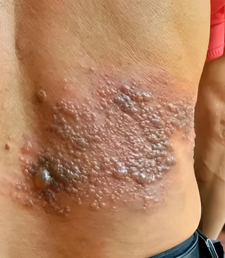 Jego ciało swędziało, myślał, że to alergia, ale trudna diagnoza… Zobacz więcej