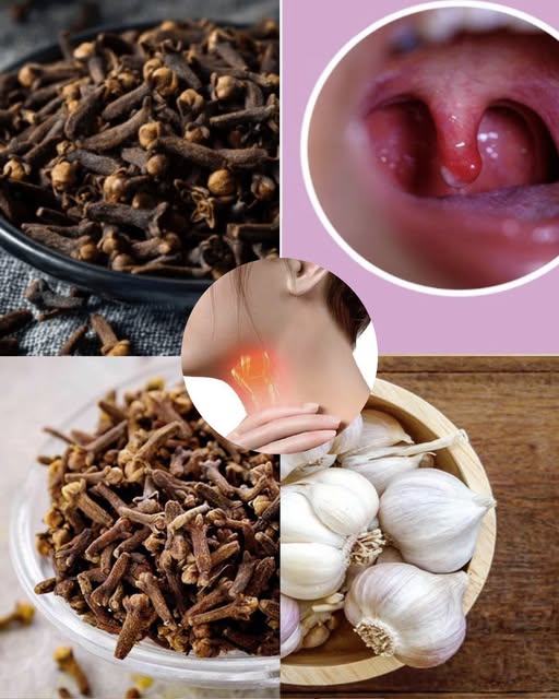 Goździki na ból gardła: naturalny sposób na zmniejszenie stanu zapalnego i przyspieszenie gojenia