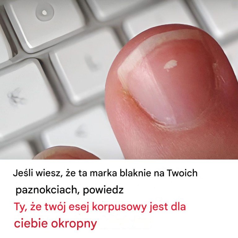Dlaczego na paznokciach pojawiają się białe plamki?